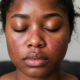 A close-up of a person with closed eyes, showing a red, butterfly-shaped rash across the nose and cheeks, signs of Lupus.
